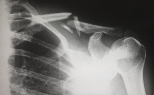 How Can I Pay for my Personal Injury Claim?
