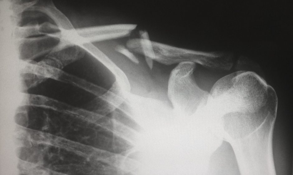X-Ray of a broken bone